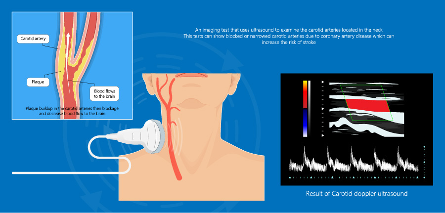 Carotid Arterial Duplex Elite Cardiovascular Group Carotid Arterial Duplex Elite Cardiovascular Group