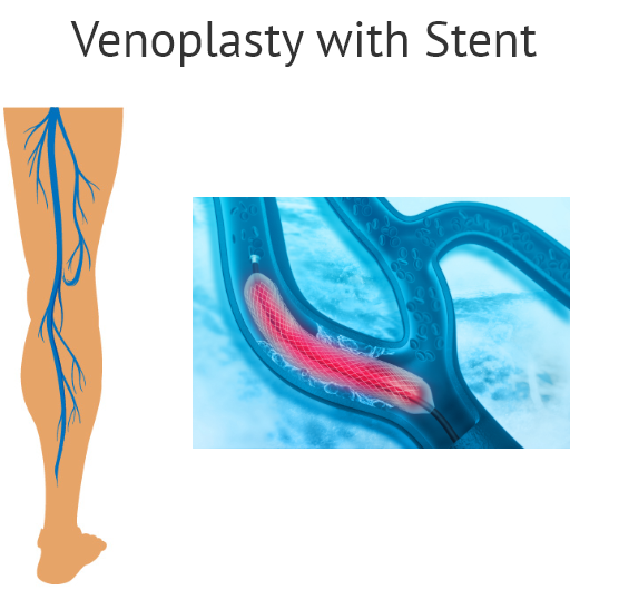 Chronic Venous Insufficiency & Varicose Veins - Elite Cardiovascular Group