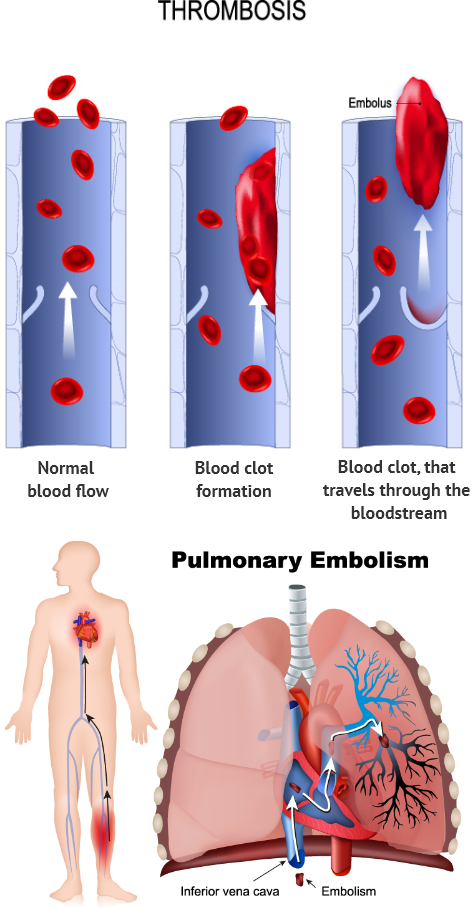 Embolism pulmonary Pulmonary Embolism