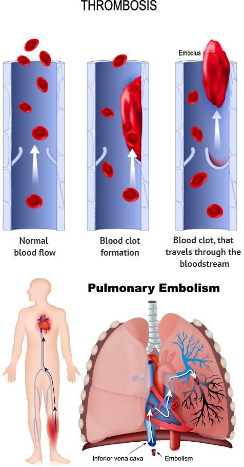 Chronic Venous Insufficiency & Varicose Veins - Elite Cardiovascular Group