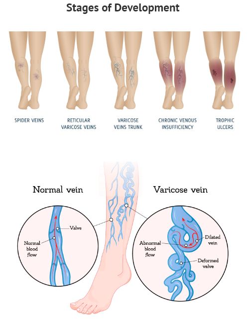 Chronic Venous Insufficiency & Varicose Veins - Elite