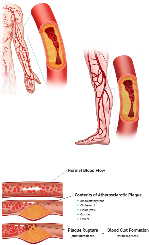 Disease peripheral vascular