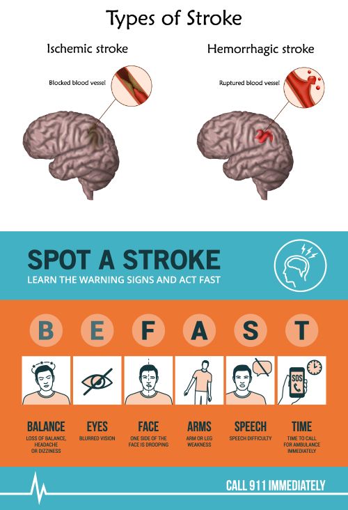 TIA (Transient Ischemic Attack): Symptoms & Treatment