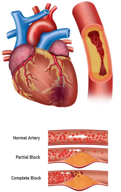 Infarction meaning