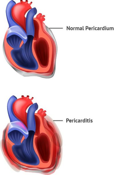 pericarditis